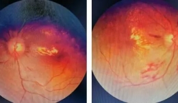 【医联体在行动】多学科全助力，共筑光明之完美