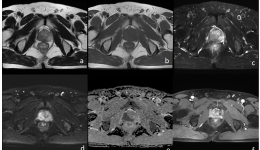 秒懂MRI系列——盆腔MR