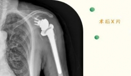 【龙中医技术】成都市龙泉驿区中医医院成功开展全区首例反式肩关节置换术！