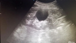 【龙中医技术】高精准，超微创！我院超声科成功开展“超声引导下肾囊肿硬化治疗术”！